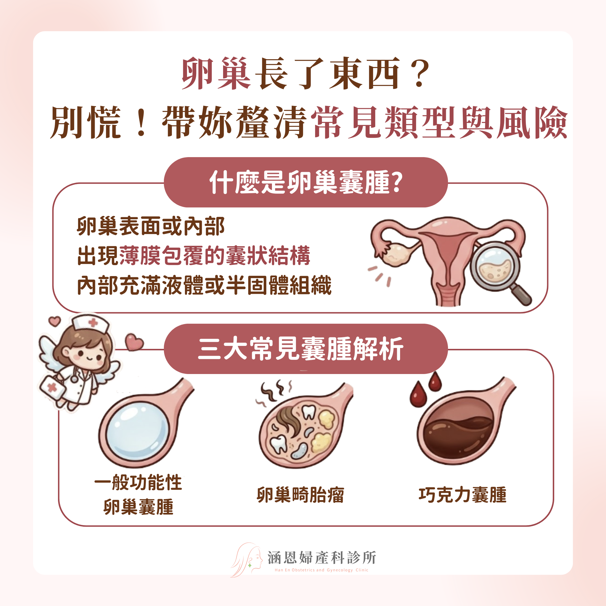 什麼是卵巢囊腫常見類型與潛在風險功能性囊腫畸胎瘤與巧克力囊腫